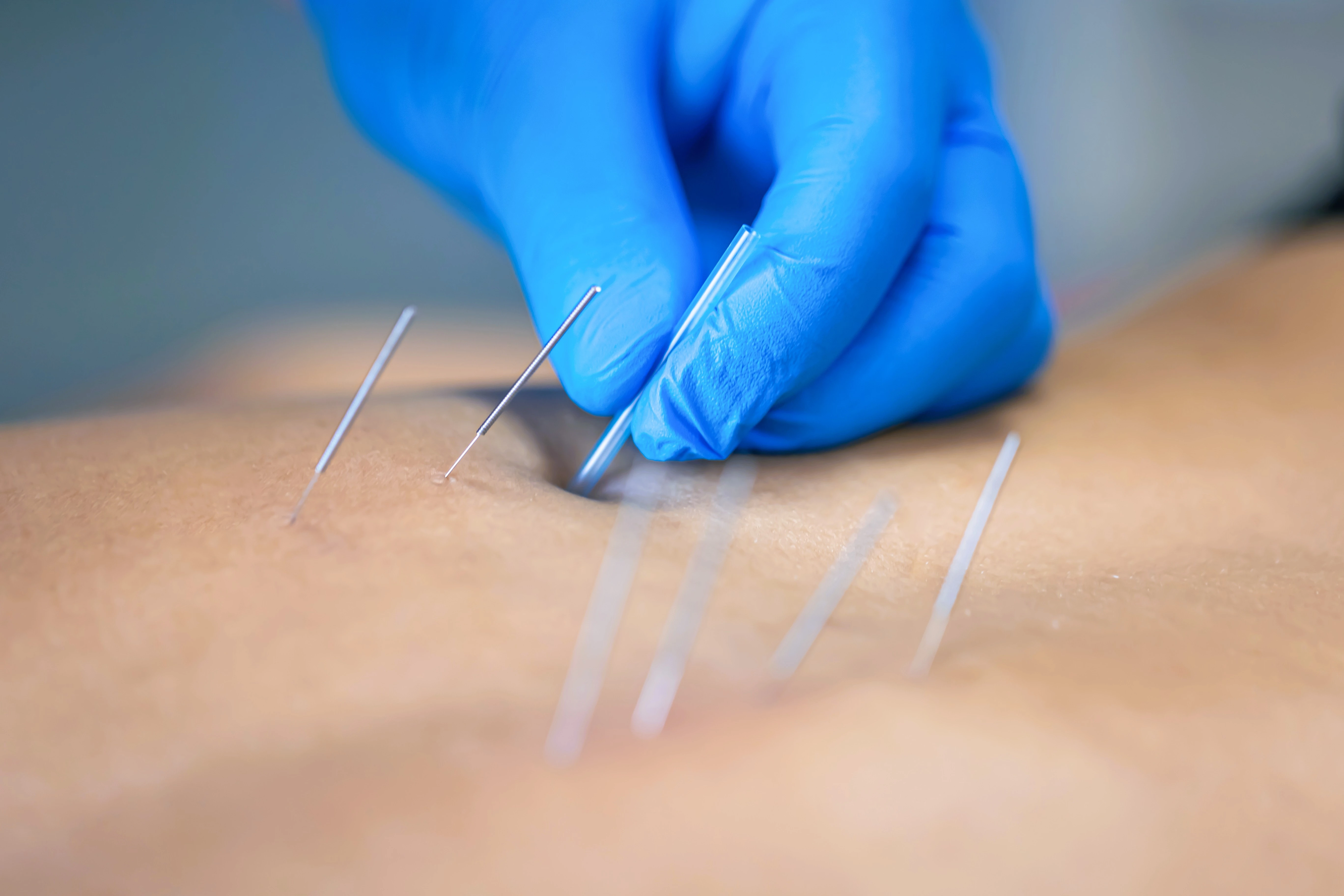 Dry Needling
